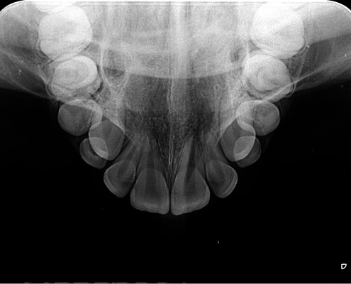 Radiografia oclusal