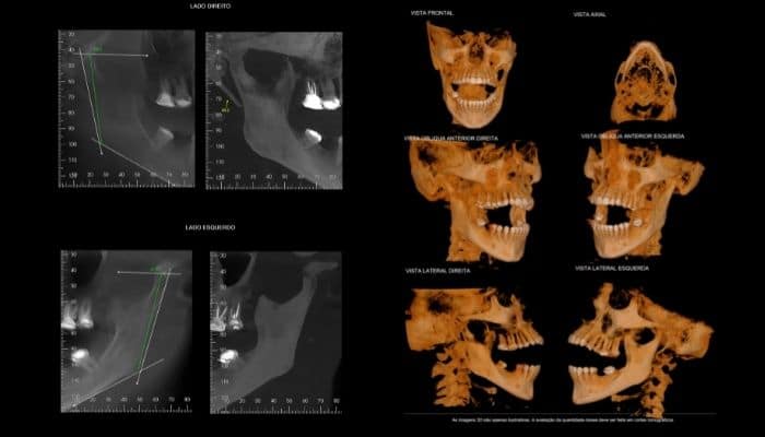 Mandíbula e Articulação Temporomandibular