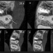 tomografia para endodontia - fratura radicular