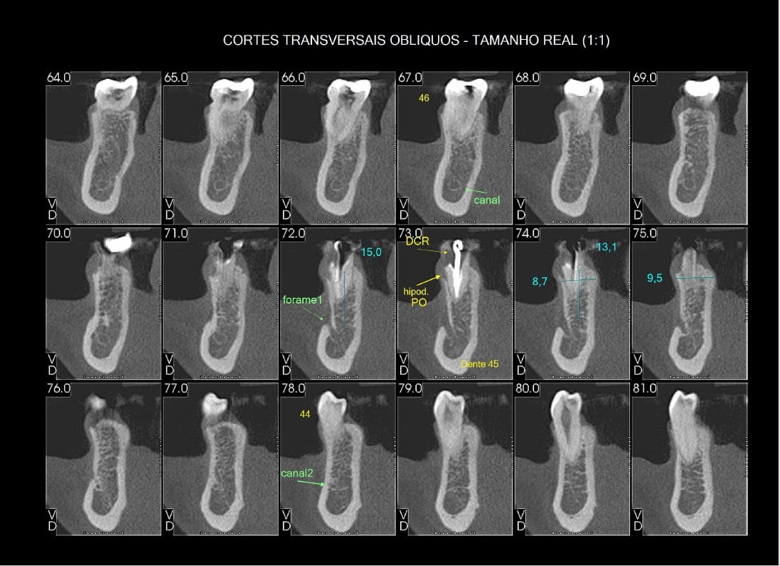 tomografia para implante