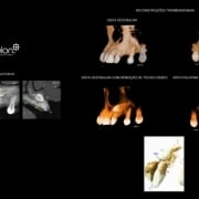 tomografia computadorizada em endodontia