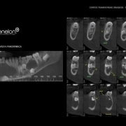 tomografia para patologia