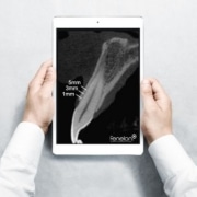 tomografia para periodontia