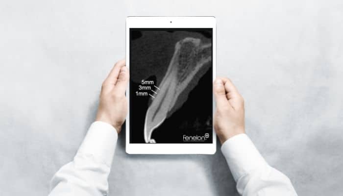 tomografia para periodontia
