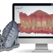 moldagem digital com escaneamento intraoral