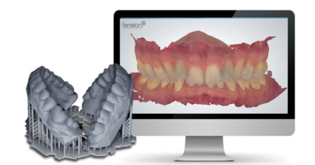 moldagem digital com escaneamento intraoral