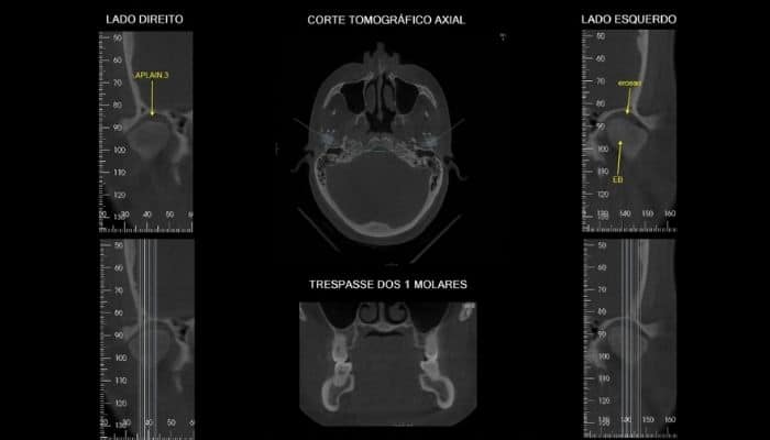 tomografia computadorizada da atm