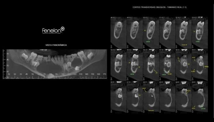 tomografia dental