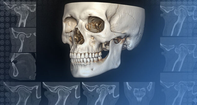 Tomografia CBCT em alterações degenerativas da ATM – Fenelon